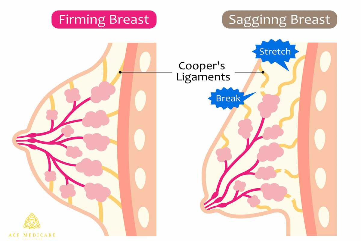 The Long-Term Effects of Aging on Breast Lift Results: What to Expect